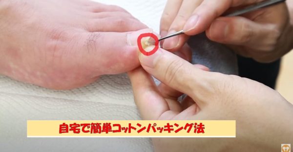 巻き爪・陥入爪の痛み緩和のための『コットンパッキング法』