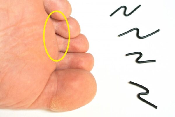 足の指の消えない痛みはモートン神経腫の疑いあり！？