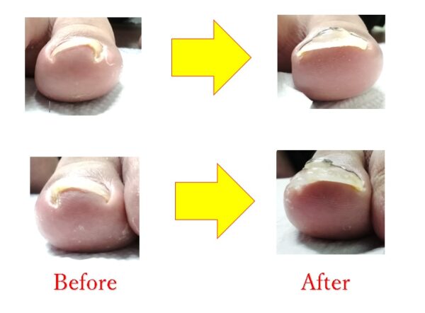 急な爪の痛みでゴルフも回れない状態が、矯正をして快調に回れるようになりました♪