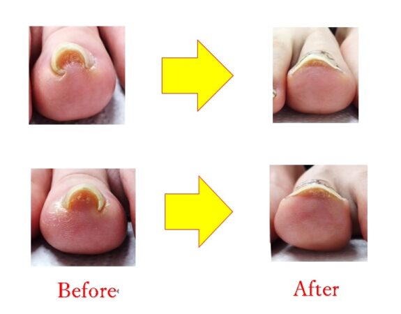 昔から悩んでいた巻き爪の悩みが解消できました