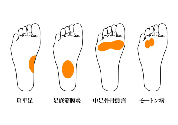 「足底筋膜炎」について